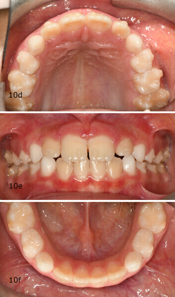Figs. 10d–f: Comparison of the intra-oral photographs at the (a–c) start and (d–f) end of treatment.