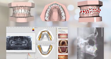 CBCT-based crown–root set-up supports anatomy-guided orthodontic planning