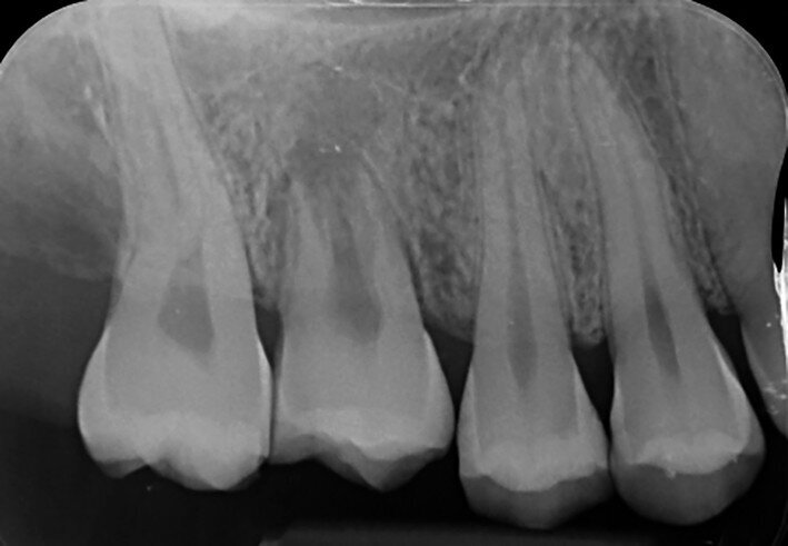 Fig. 19c: Radiographs: One-year recall.