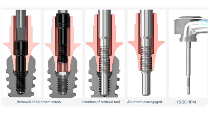 Keystone Dental Group – Conical Connection Abudment Retrivial Tool