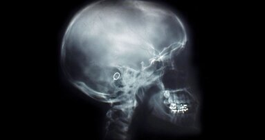 Unikatowa technologia modyfikacji implantów kostnych