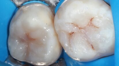 Funkcjonalna odbudowa estetyczna w odcinku bocznym – opis przypadku