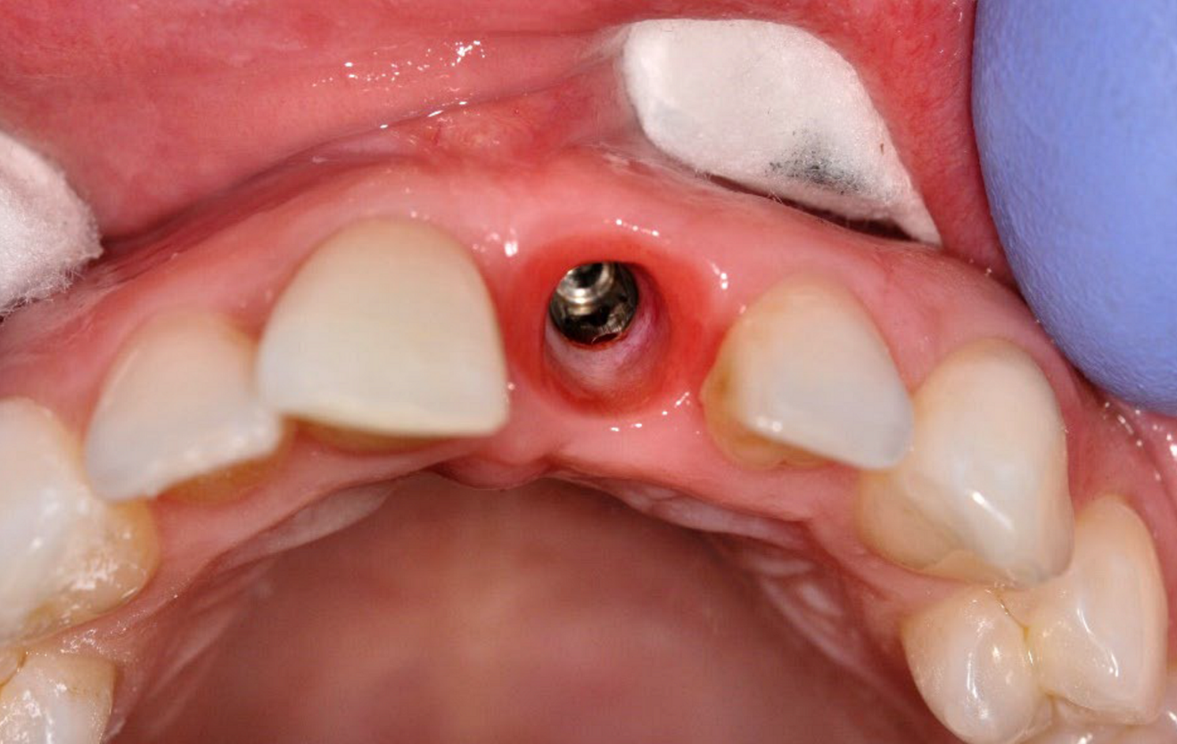 ... and the resulting contoured tissue at 12 weeks post-op (f). 