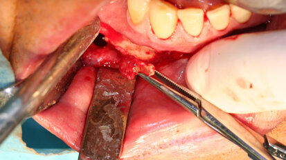 Naše zkušenosti s technikou kostní piezochirurgie po 15 letech klinického používání