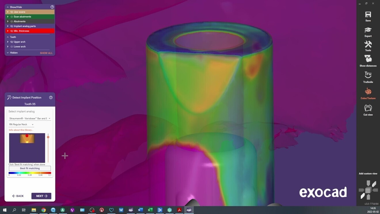 Fig. 6: Digital impression of the patient’s oral cavity with scan body alignment in dental CAD software.