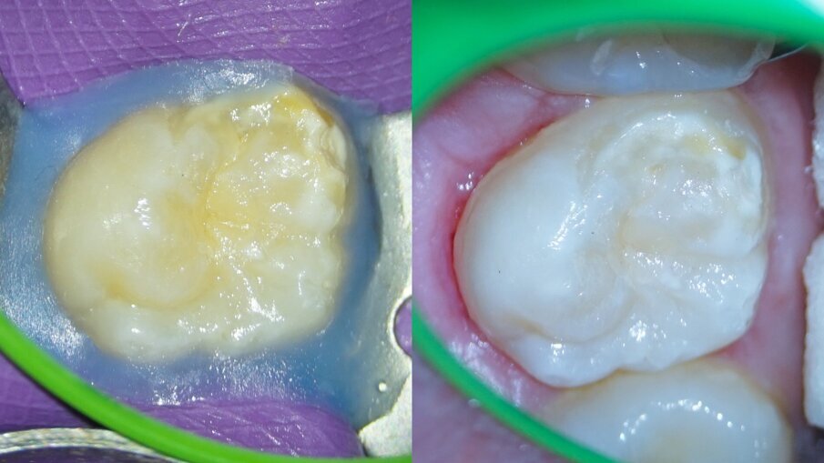 Figs. 10a & b: Adhesive coronal restoration, just before (a) and after (b) removal of the isolation.
