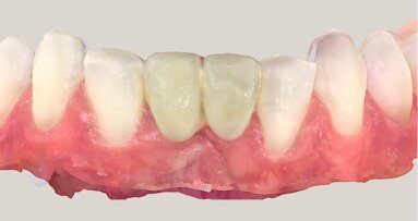 Optimising design and shade—replacement of a resin-bonded bridge for aesthetic reasons