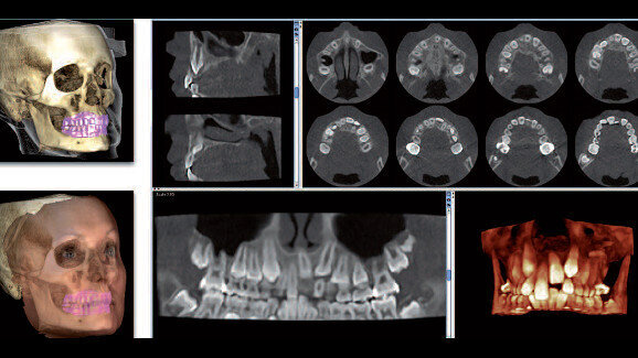 The Planmeca Ultra Low Dose protocol changes 3-D imaging