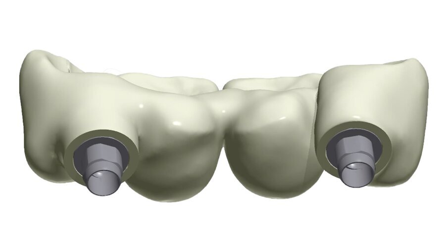 Fig. 38_Il ponte tra gli impianti in Zirconia rappresenta un progetto complesso tra il rispetto del tunnel mucoso, l’anatomia vestibolare, gli spazi circolari e il foro per l’avvitamento coronale.