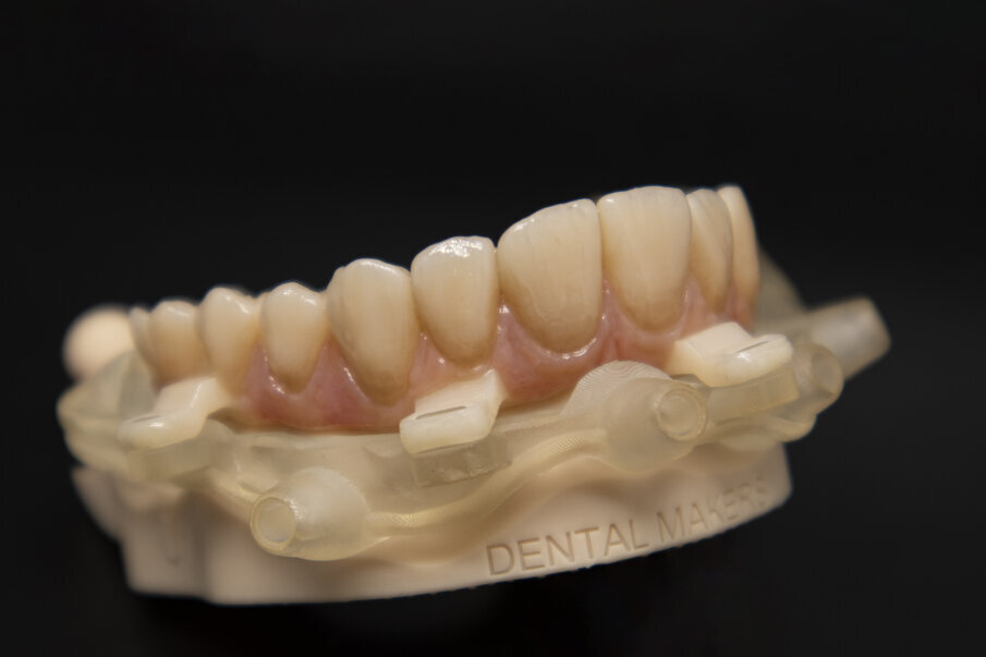 Fig. 13_Un limpido esempio delle potenzialità estetiche e tecniche delle resine stampate e caratterizzate in laboratorio.