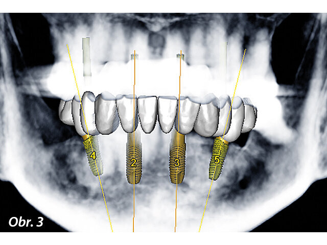 Obr. 3: Plánování implantace prováděné pomocí softwaru SimPlant (Dentsply Sirona Implants)