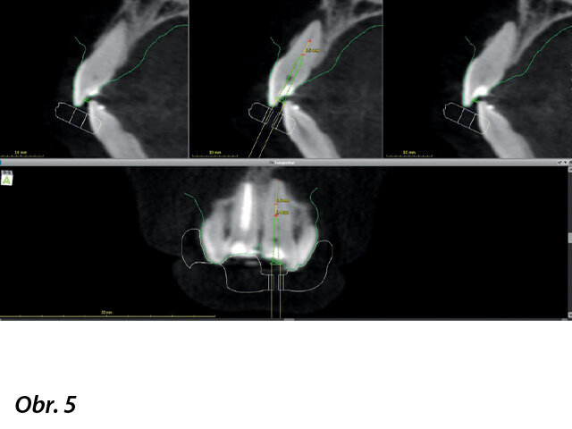 Virtuální plánování navigované endodoncie s coDiagnostiX.