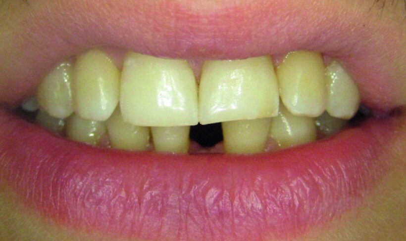 Fig. 8: Initial clinical situation: tooth #31 is missing.
