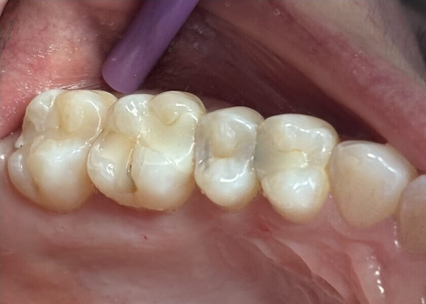 Fig. 19: Clinical view of the old composite restorations with recurrent caries on the molars and premolars.