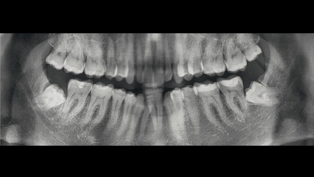 Un caso di IIa Classe con morso aperto e mancanza dell’incisivo centrale destro inferiore, trattato ortodonticamente con un trattamento ibrido con allineatori
