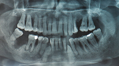 Protesi rimovibile superiore e inferiore su barra