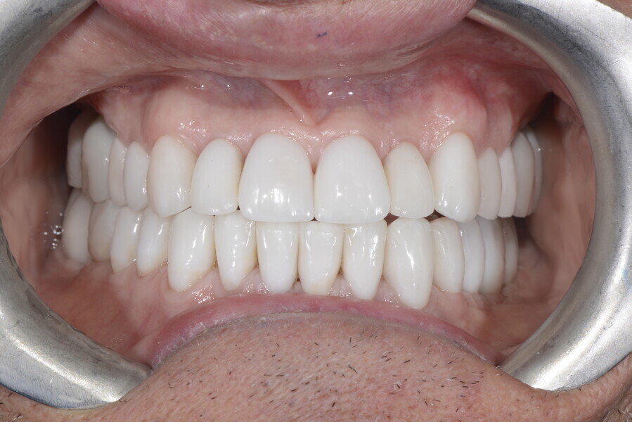 Fig. 27f:  Disclusion on the right.