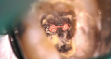 Le traitement d’une molaire mandibulaire calcifiée : un protocole des temps modernes