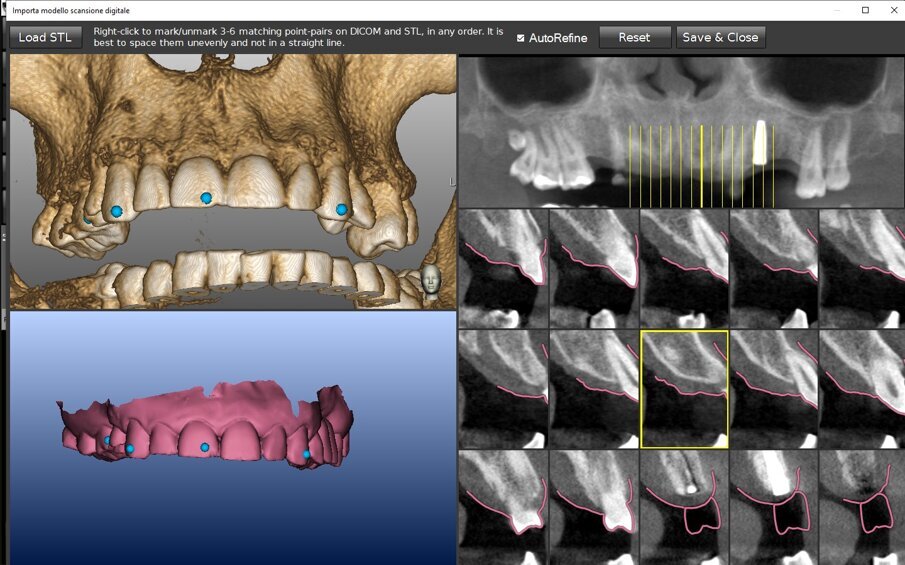 Figg. 3a, 3b - La registrazione di un modello con ceratura diagnostica nel software Navident® by Claronav®. a) Identificazione di punti di accoppiamento; b) integrazione finale del modello con ceratura diagnostica nel software per la pianificazione. N.B. Questo uso dell’algoritmo di registrazione è esclusivamente diagnostico in una tecnica di chirurgia navigata.
