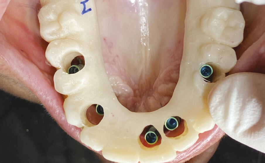 Fig. 6 - Adattamento e posizionamento della protesi in resina.