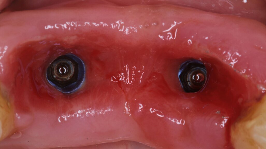 Rise of minimally invasive techniques for soft tissue augmentation – A tale of promise and pitfalls