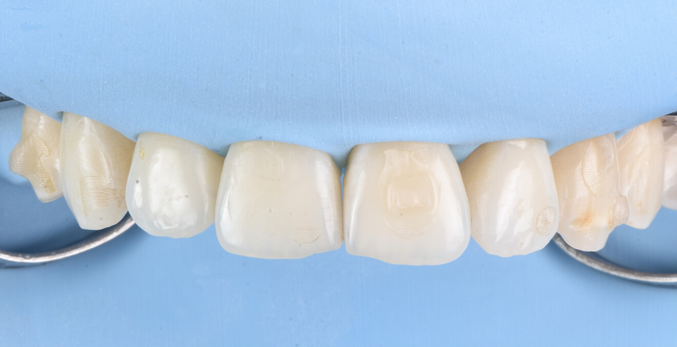 Figg. 10, 11 - Restauro margini incisali.