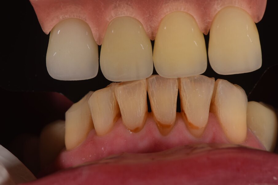 Fig. 43_La presa del colore è sempre un aspetto delicato e talvolta impreciso nella comunicazione con l’odontotecnico, siamo soliti fornire fotografie con scale cromatiche con filtri depolarizzanti associati anche all’uso di uno spettrofotometro per correlare i dati avvicinandosi alla mappatura del colore dei denti residui.