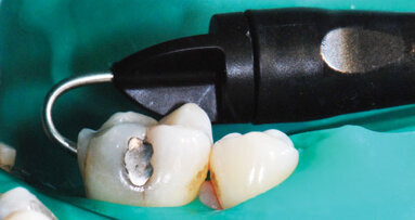 Sulzer Mixpac 1 ml system delivers big on flexibility