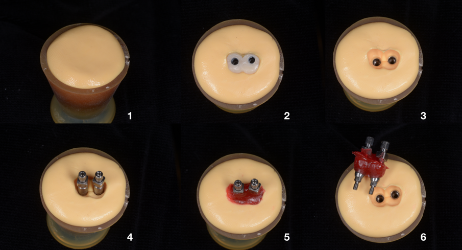 Fig. 3_Fasi di realizzazione di cappette d’impronta (pick-up) personalizzate: a) dappen con materiale da impronta; b) inserimento del provvisorio nel dappen; c) rimozione del provvisorio dopo che il materiale si è polimerizzato; d) collegamento del pick-up; e) iniezione della resina autoindurente; f) rimozione dei pick-up personalizzati dagli analoghi.