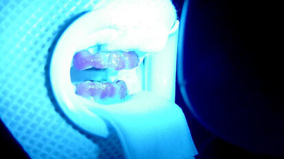 La blancorexia o la obsesión por los dientes blancos La blancorexia o la obsesión por los dientes blancos