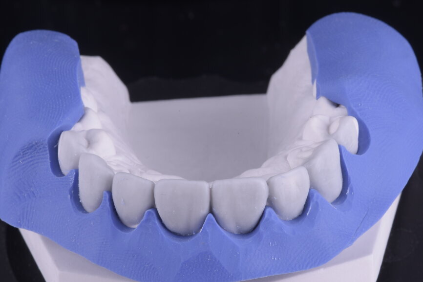Fig. 43: Surgical silicone index for crown lengthening and cervical contours marked with a red pencil.