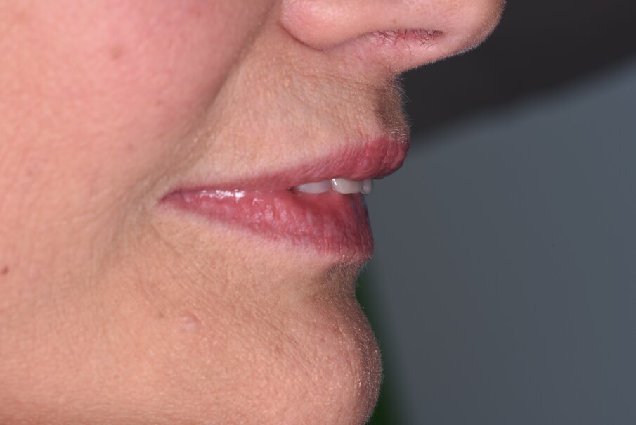 Fig. 3_Profilo della paziente col provvisorio in sede.