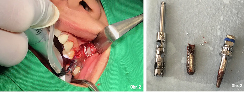 Explantace a okamžitá implantace kombinací reverzního krouticího momentu a trepanační frézy