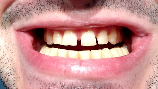 Czy diastema dodaje atrakcyjności?