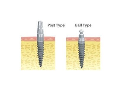 ProTem Implant System