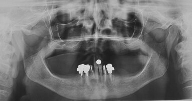 Impianti short a carico immediato in grave atrofia mandibolare