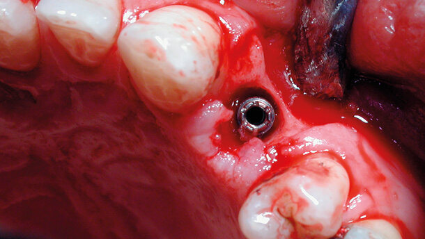 Il laser in implantologia: azioni e vantaggi. Analisi dell’utilizzo dei laser in chirurgia dopo 15 anni di follow-up dalla fondazione di AIOLA, fatti e certezze