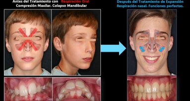 Sellado bucal y respiración oral: qué dice realmente la ciencia