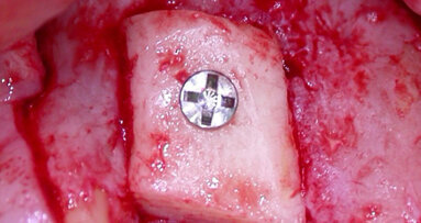 Innesti ossei e implantologia a protesizzazione immediata in zone ad alta valenza estetica