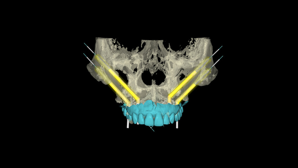 Combining robotic and dynamic implant surgery and photogrammetry for full-arch rehabilitation: A quad zygoma and mandibular implant case report