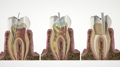 Discover SWEEPS for a more effective endodontic treatment at IDS