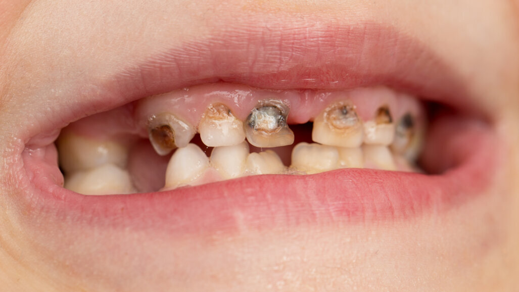 Scotland’s poorest paying the price for dental crisis, says British Dental Association