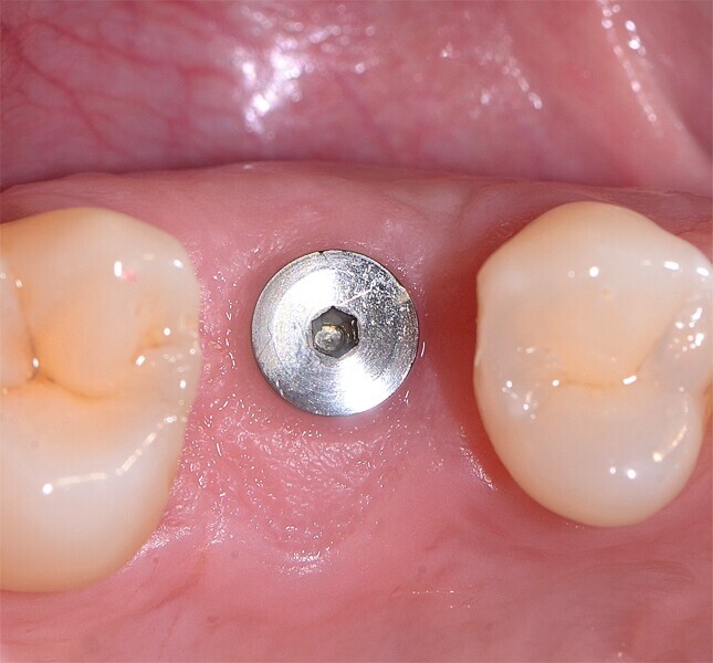 Fig. 11 : Intégration tissulaire parfaitement réussie après deux mois.