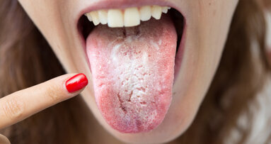 “COVID tongue”—dentists urged to remain alert to symptoms in the oral cavity