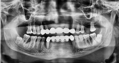 Treatment of patients with severe periodontal disease in general dental practice