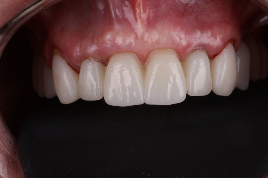 Fig. 10: Temporary bridge