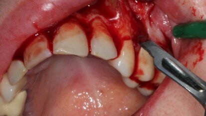 Przedprotetyczne postępowanie chirurgiczne z wykorzystaniem autologicznych preosteoblastów hodowanych in vitro