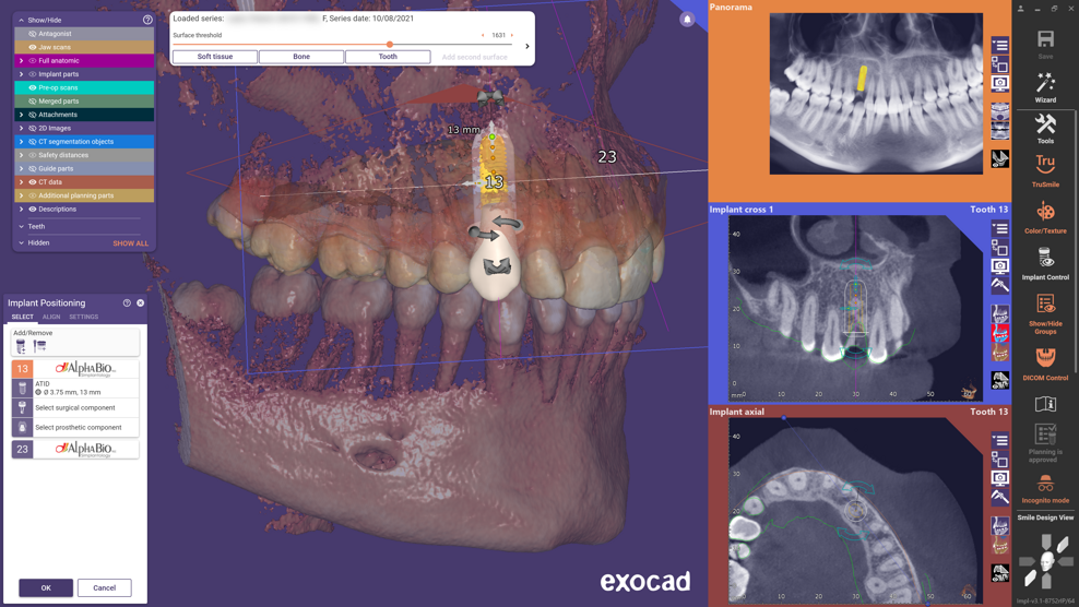 Exoplan’s intuitive workflow guides users through the entire process―from implant planning to surgical guide design and manufacturing. 