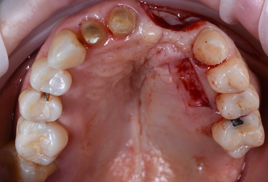 Fig. 9 - Sede del prelievo epitelio connettivale dal palato.