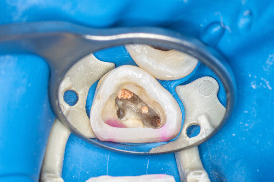 Fig. 22: The pulp chamber of the second molar with filled canals.